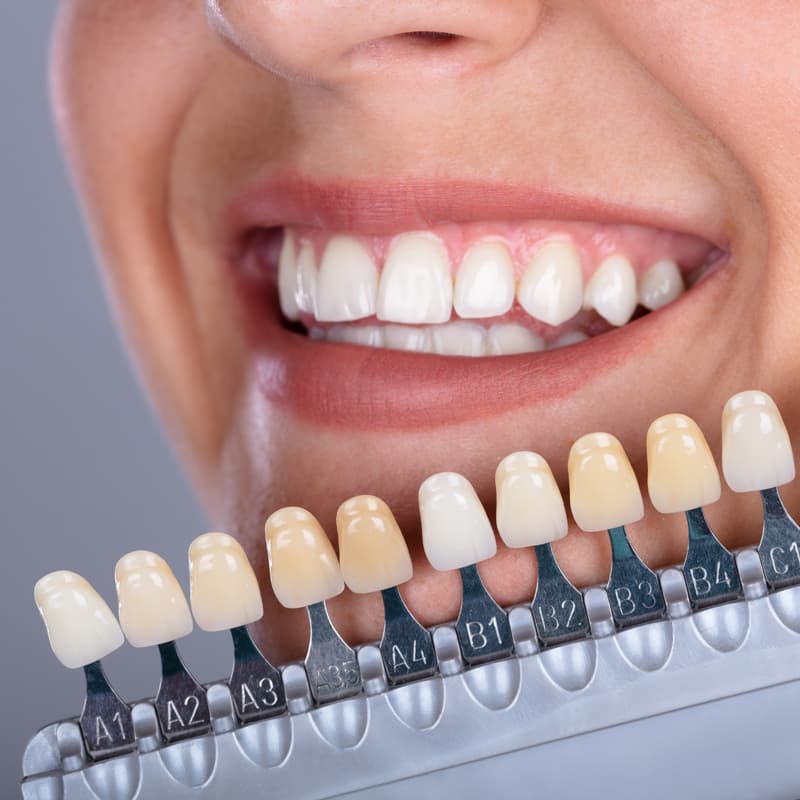 Blanqueamiento dental