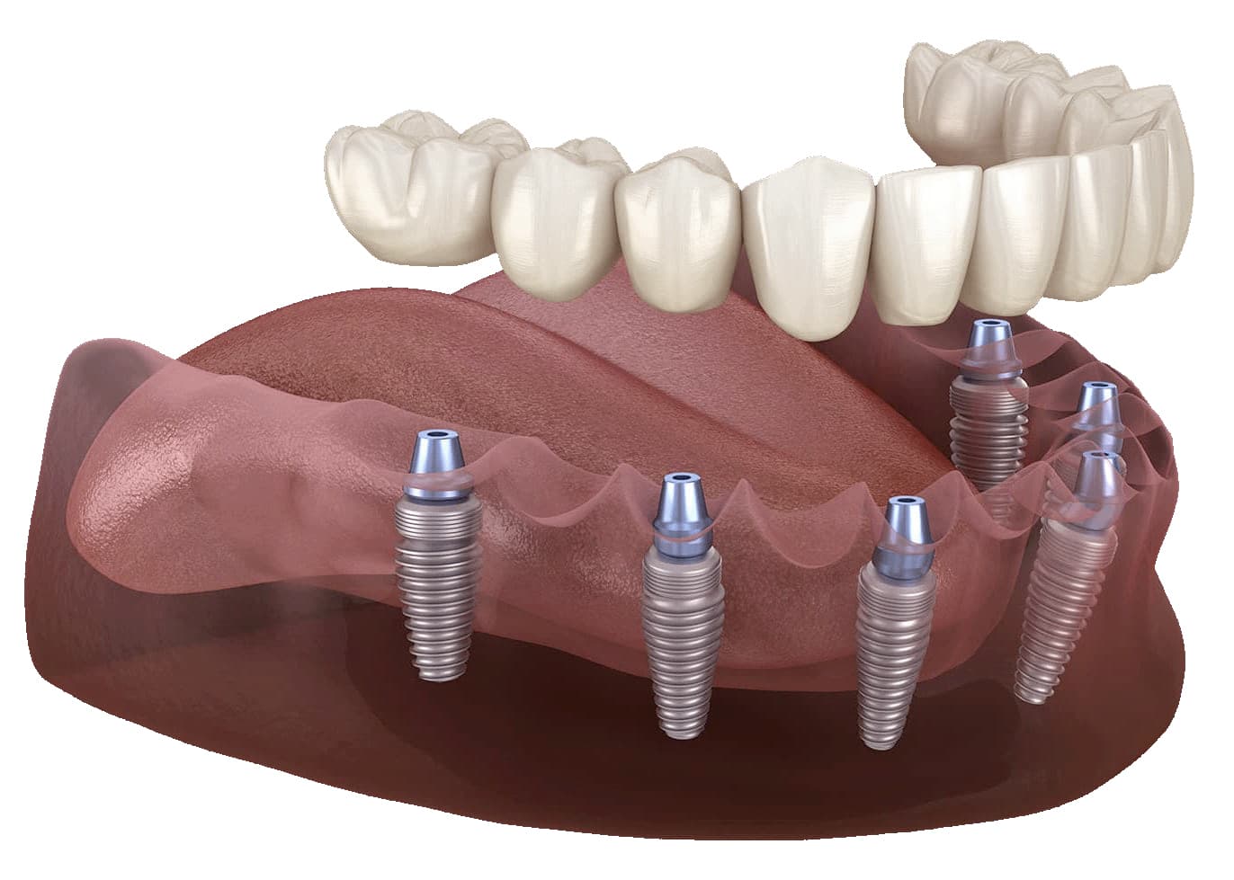  implantes en Pontevedra