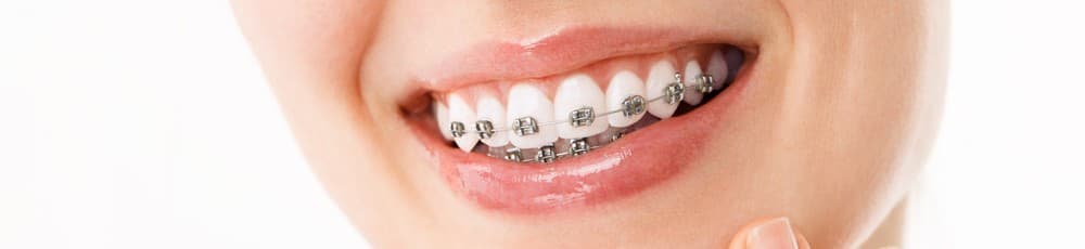 Brackets de metal